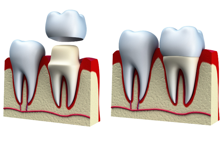Установка коронки лучше всего для восстановления утраченных зубов